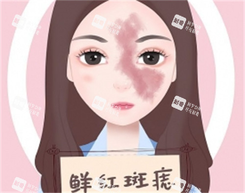 什么是鲜红斑痣 什么是鲜红斑痣
