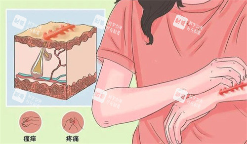 疤痕