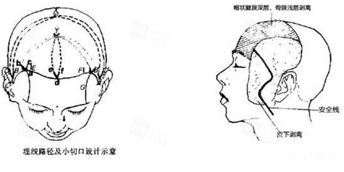 面部小切口悬吊术 面部小切口悬吊术