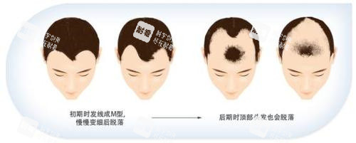 脱发步骤动画演示图