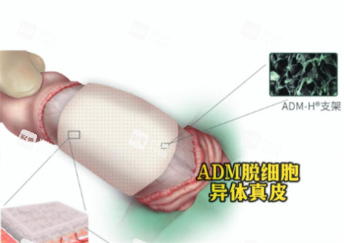 阴茎生物补片ADM材料是什么
