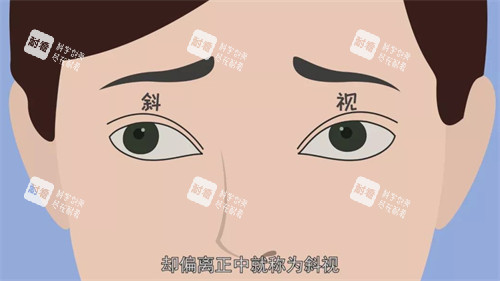 斜视动画示意图 斜视动画示意图