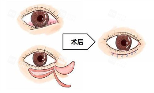 倒睫手术怎么做的 倒睫手术怎么做的