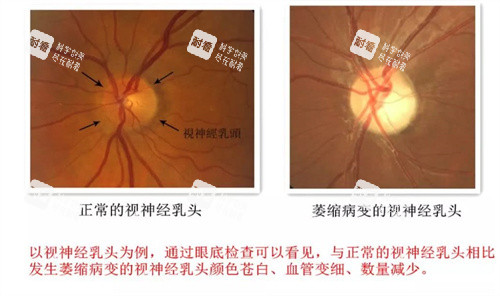 视神经萎缩对比 视神经萎缩对比