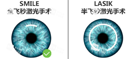 半飞秒和全飞秒手术区别图 半飞秒和全飞秒手术区别图