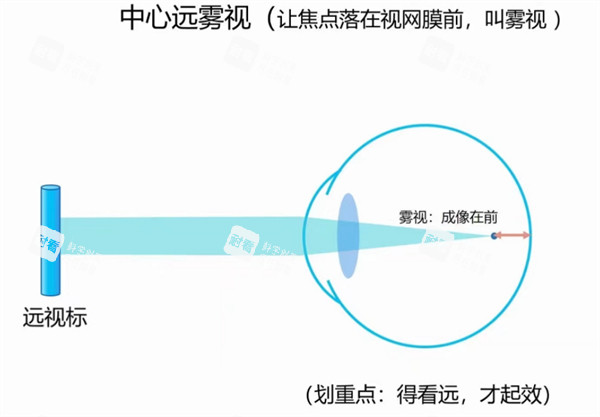 离焦眼镜治疗近视原理图解 离焦眼镜治疗近视原理图解