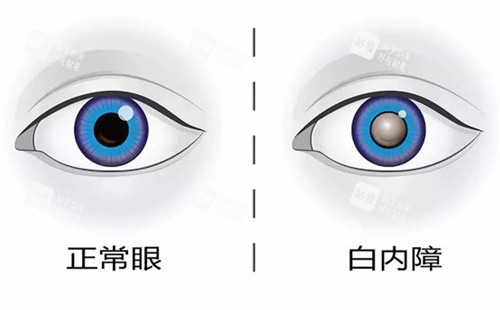 正常眼睛和白内障 正常眼睛和白内障