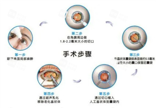 白内障手术步骤 白内障手术步骤