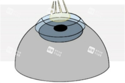 Refractive-Surgery-Techniques-1024x493_副本 Refractive-Surgery-Techniques-1024x493_副本