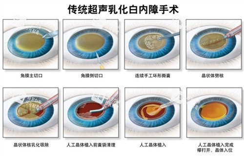 白内障超声乳化手术流程图 白内障超声乳化手术流程图