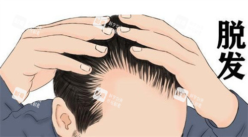 发际线后移 发际线后移