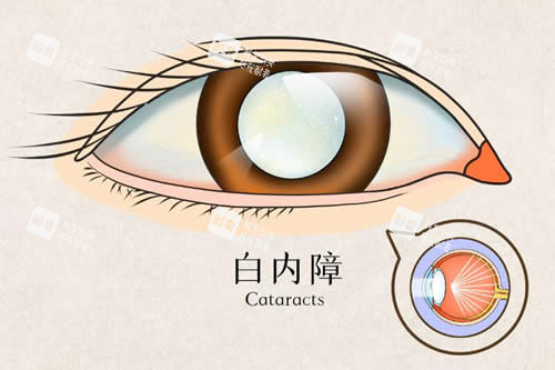 白内障卡通示意图.jpg 白内障卡通示意图.jpg