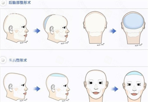 后脑勺整形