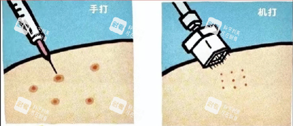 水光针注射 水光针注射