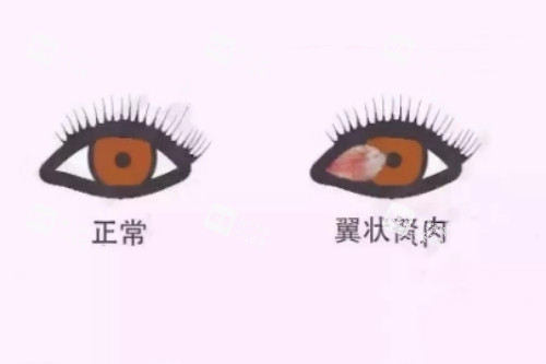 翼状胬肉与正常眼睛对比 翼状胬肉与正常眼睛对比
