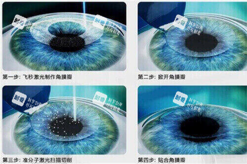 近视矫正手术过程示意图 近视矫正手术过程示意图