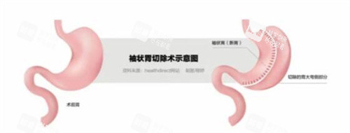 袖状胃切除手术示意图