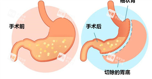 袖状胃切除手术前后对比卡通