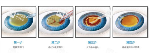 白内障手术过程