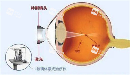 玻璃体激光治疗仪 玻璃体激光治疗仪