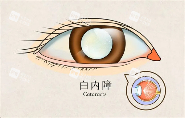 白内障怎么办 白内障怎么办