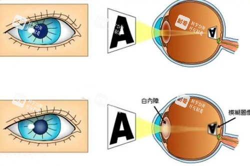 白内障和正常眼睛卡通对比图 白内障和正常眼睛卡通对比图