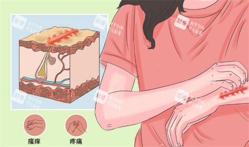 疤痕疙瘩的样子 疤痕疙瘩的样子