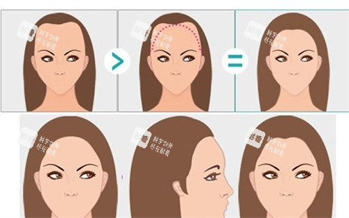 女性m型发际线卡通图 女性m型发际线卡通图