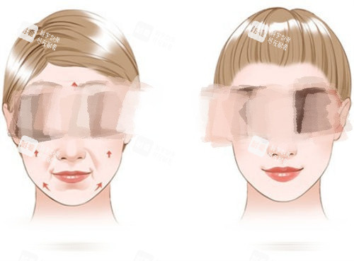 拉皮手术提拉方向示意图.jpg