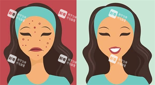 祛痘前后对比图 祛痘前后对比图