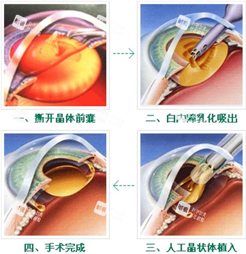 白内障手术过程图 白内障手术过程图
