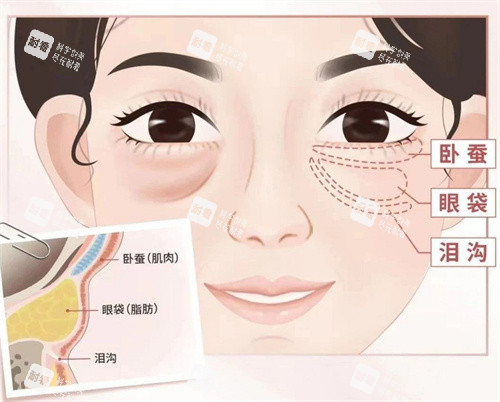 眼袋图片展示