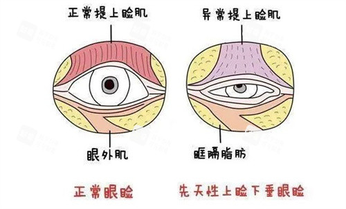 小睑裂综合征 小睑裂综合征