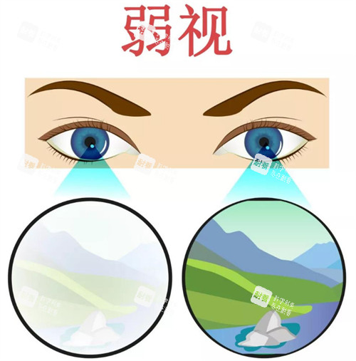 弱视和正常眼镜区别