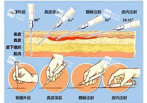 爱贝芙注射示意图 爱贝芙注射示意图