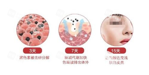 点阵激光的恢复过程 点阵激光的恢复过程