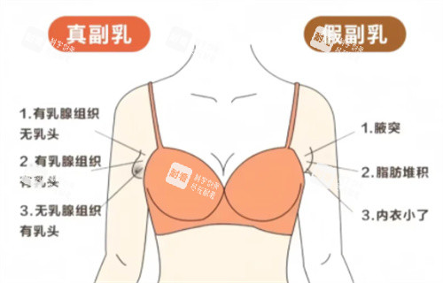 真假性副乳对比 真假性副乳对比