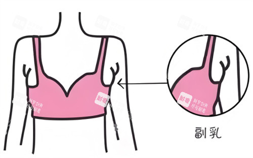 去副乳部位图片 去副乳部位图片