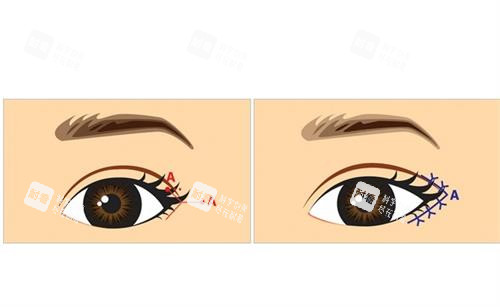 开外眼角前后对比图
