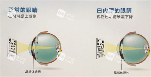 白内障的眼睛示意图