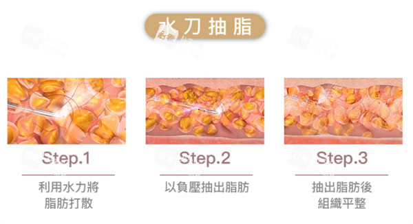 水刀抽脂原理