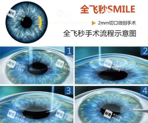 全飞手术流程示意图 全飞手术流程示意图