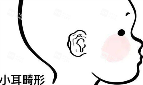 小耳畸形耳部状态 小耳畸形耳部状态