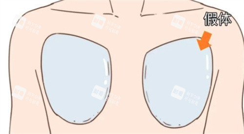 男性隆胸.jpg 男性隆胸.jpg