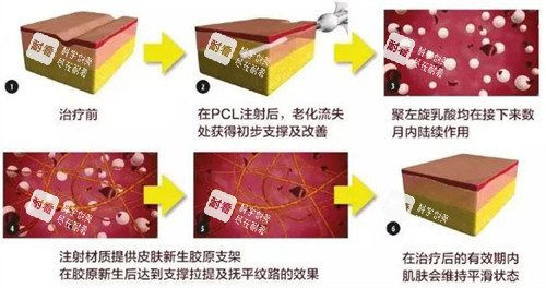 爱塑美童颜针注射前后变化图解