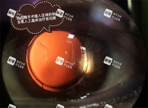 白内障手术细节图 (2) 白内障手术细节图 (2)
