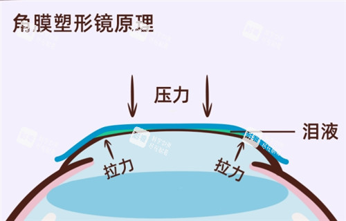角膜塑形镜原理过程