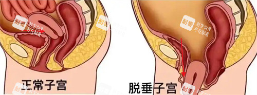 子宫脱垂前后对比 子宫脱垂前后对比
