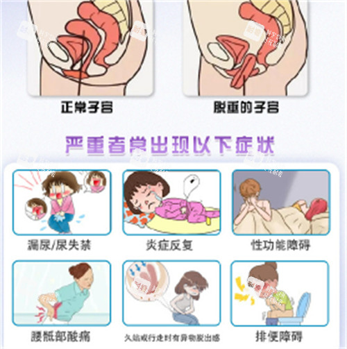 子宫脱垂的症状 子宫脱垂的症状