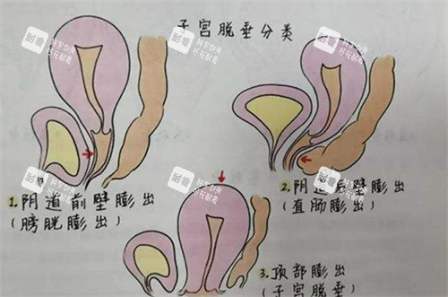 子宫脱垂的不同程度展现 子宫脱垂的不同程度展现